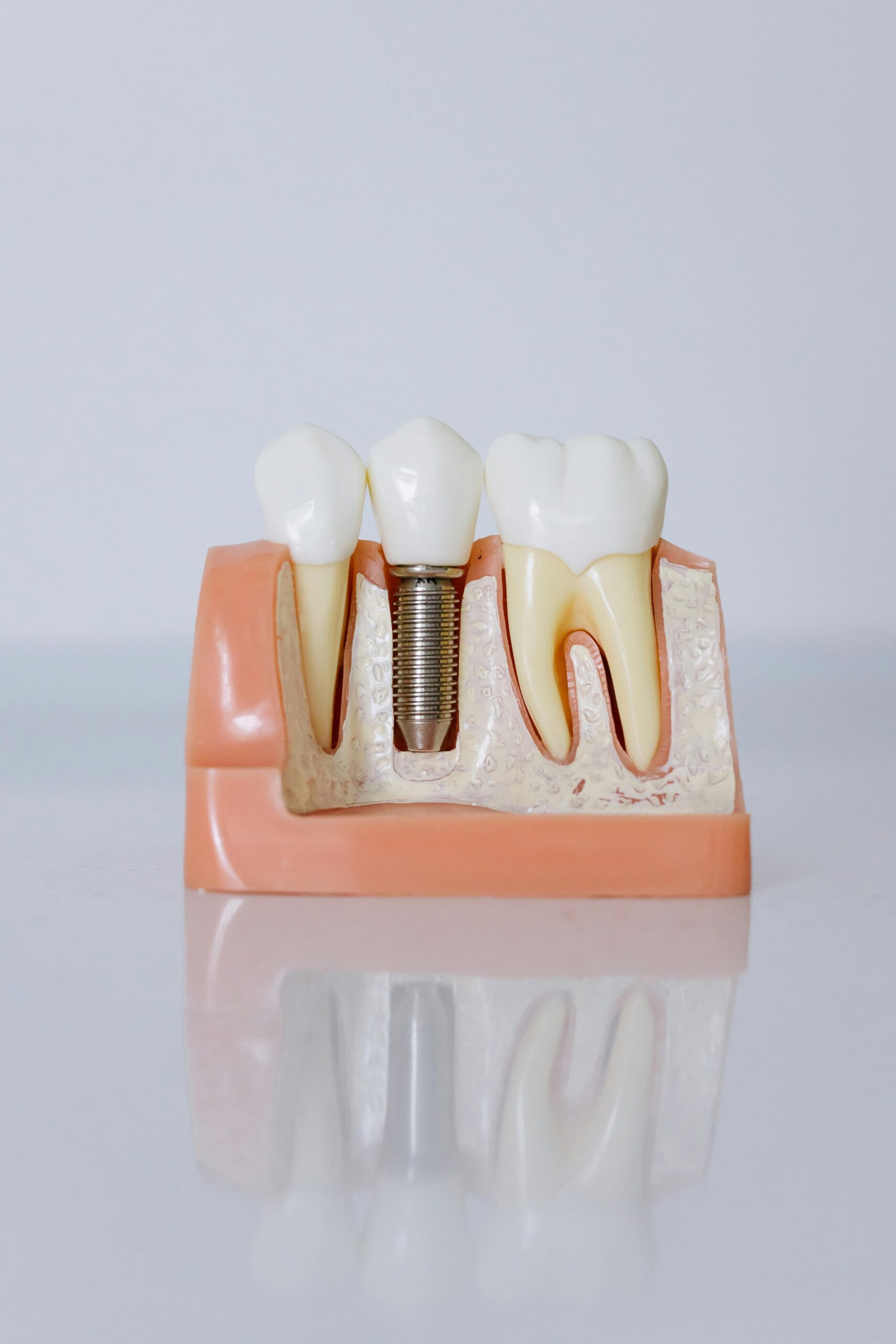 Detailed view of a dental implant model showcasing teeth and gum anatomy for dental education.